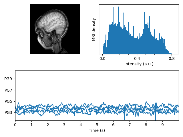 risonanza magnetica con eeg